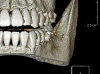 こだま歯科医院（インプラント専門サイト）CT立体画像